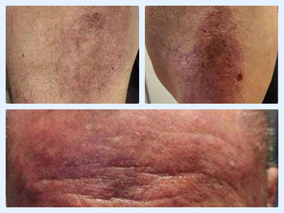 Baseline photo of a LISRAYA patient showing severe ulcerative skin lesions and intense facial erythema