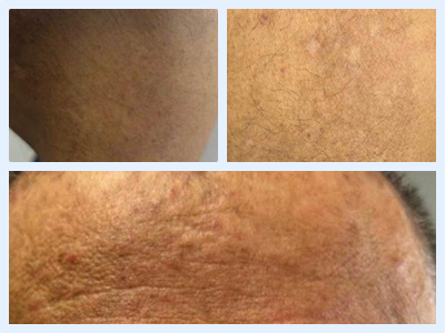 Week 52 photo of the same LISRAYA patient showing healed ulcerations and widespread facial clearing